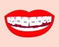 Smile mouth with white crooked teeth in braces. Vector isolated elements.